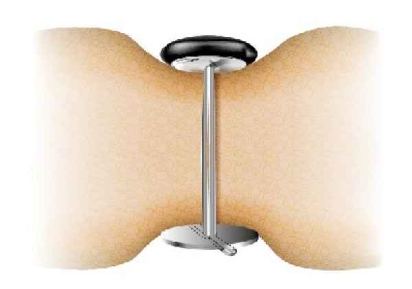 Polsterknöpfe mit Splint mit Ihrem Stoff bezogen